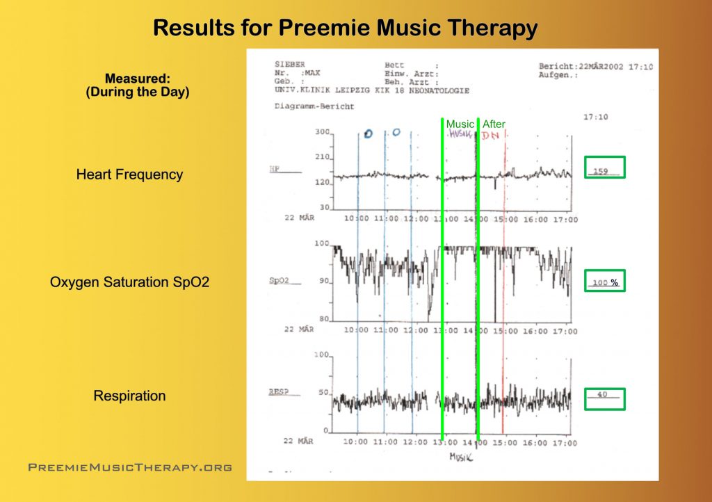 22) Clinical Research Example 2 Preemie Music Therapy by Baby Music In Tune